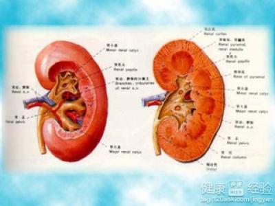 嬰兒腎積水如何治療