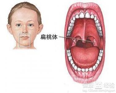 每年均因扁桃體發炎而引起高熱驚厥咋辦呢