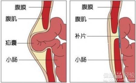 小兒疝氣手術後該怎麼樣保養