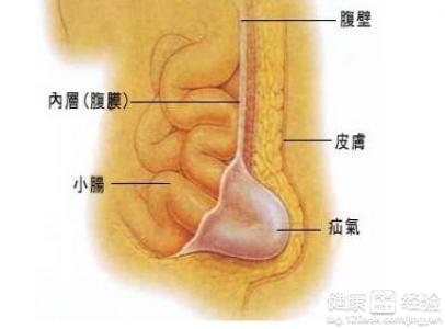 2個月的嬰兒得了小兒疝氣怎麼辦